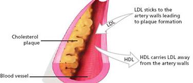 Here's what Bad LDL looks like in your body
