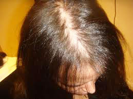 A woman losing hair